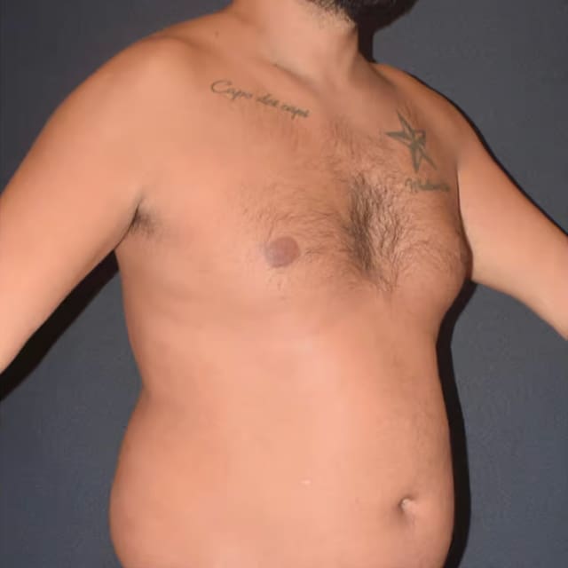 Before and after HD VASER Liposculpture