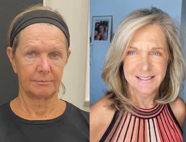 Face Lift before and after image